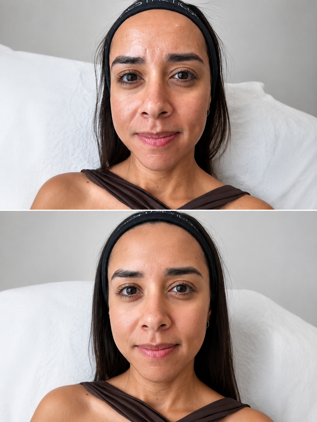 Antes e depois — Rejuvenescimento facial