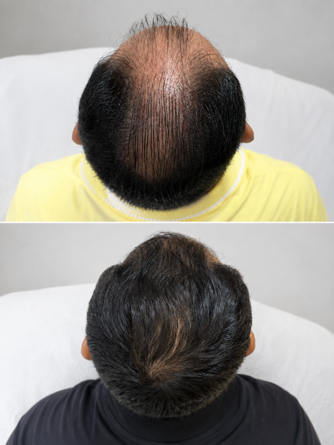 Antes e depois — Densidade capilar — coroa