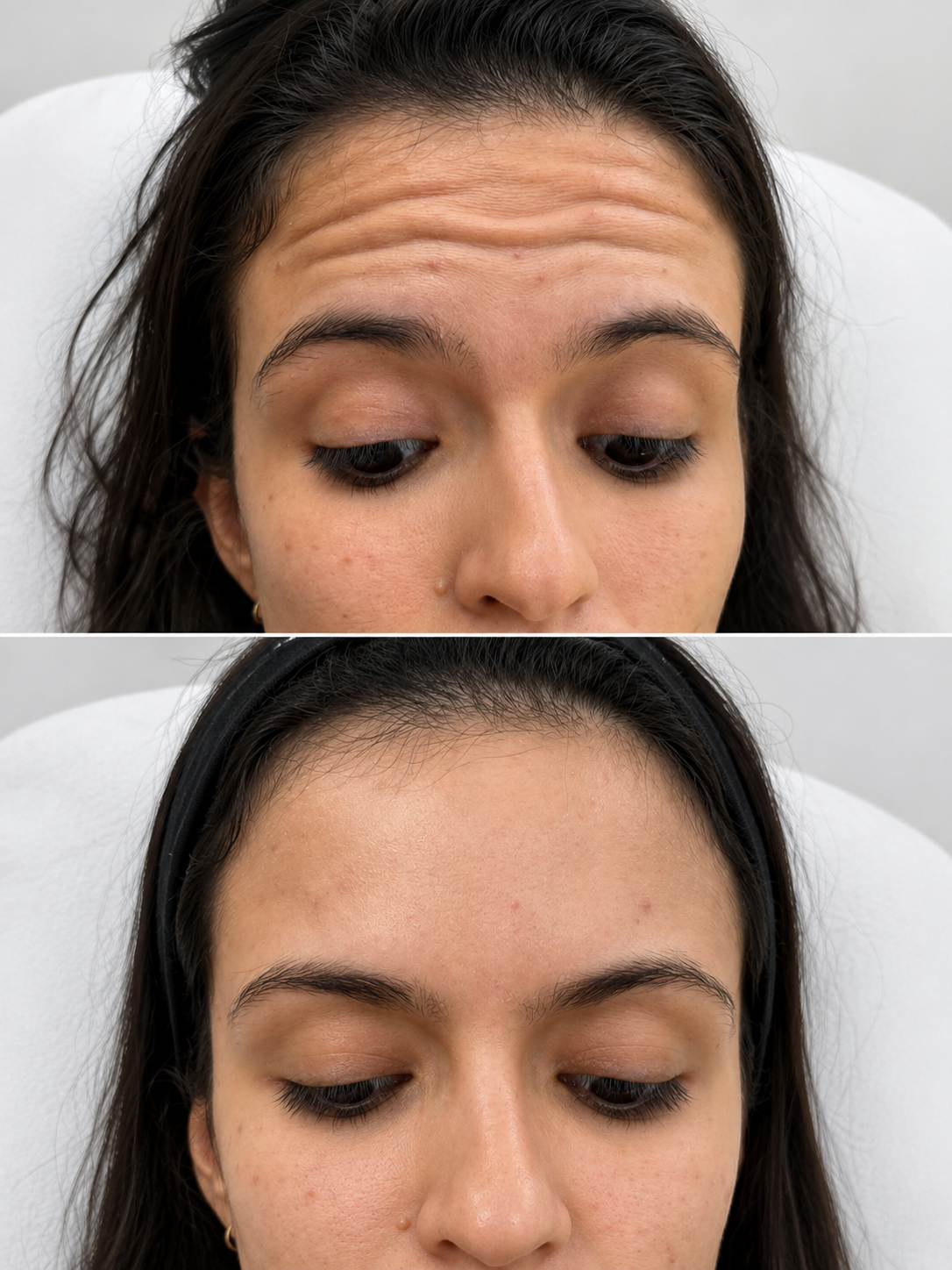 Antes e depois — Linhas de expressão